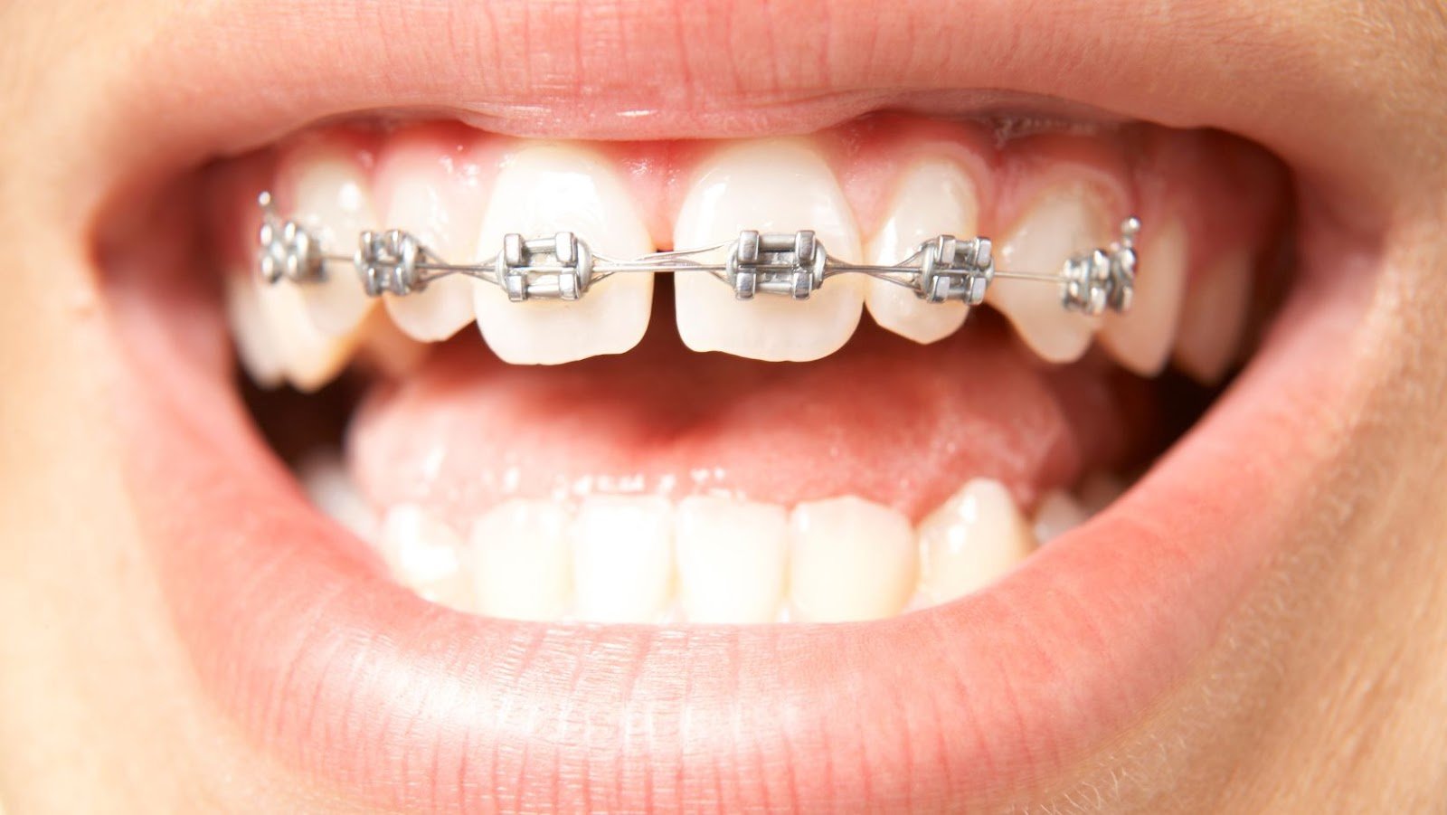 Wish to Get Braces for Teeth? 4 Things to Know First