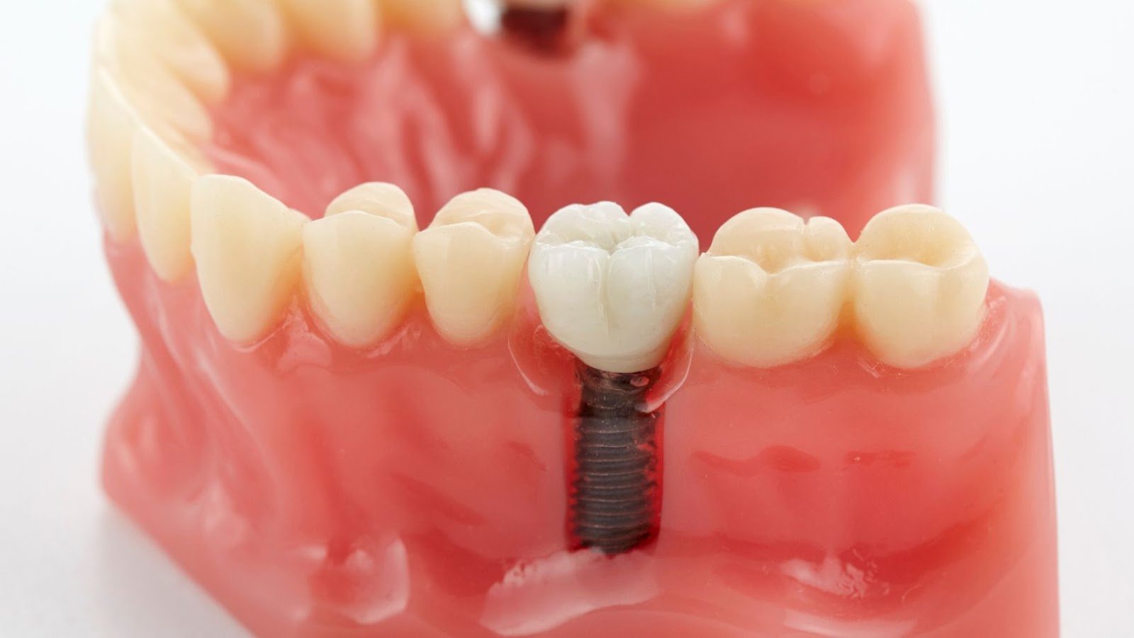 Tips for Looking After Your Dental Implants