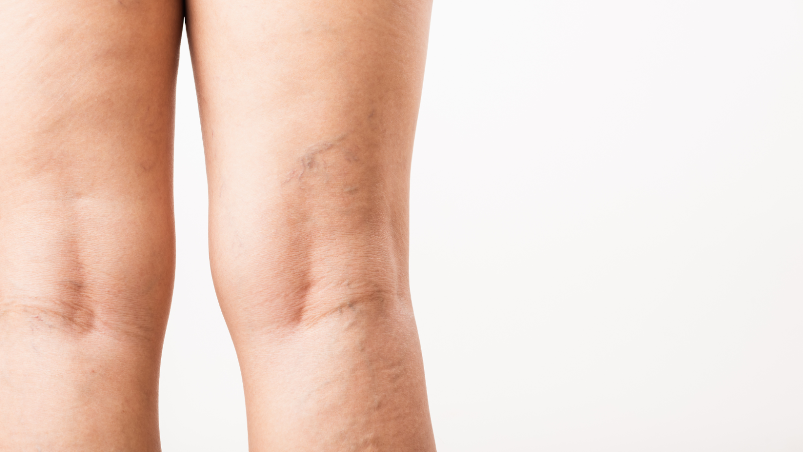 What You Need to Know About Vein and Aesthetic Medicine