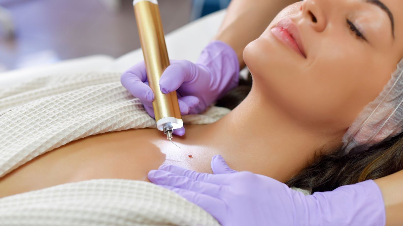All About Aesthetic Removal of Skin Tags