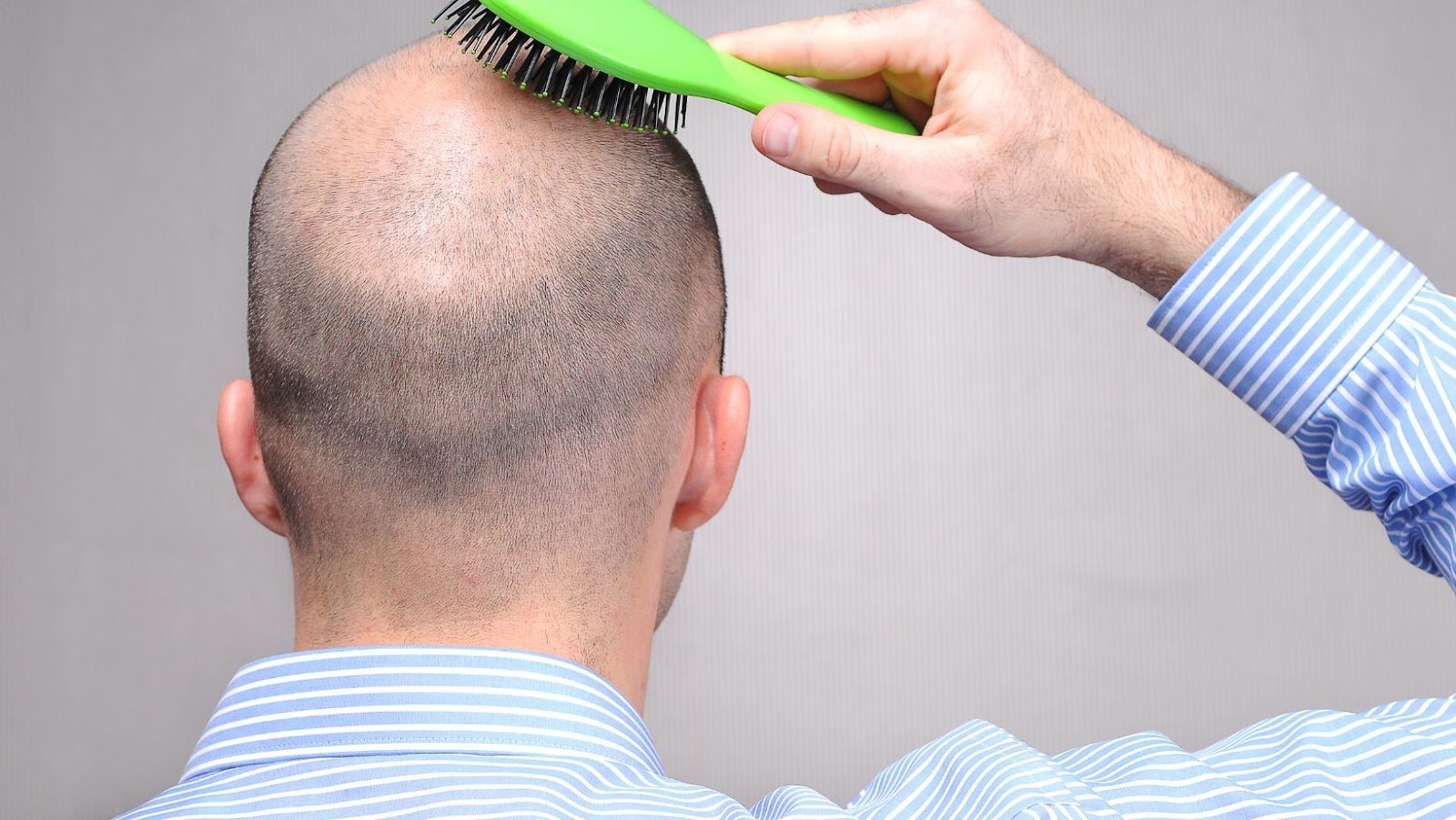 What Happens During a Hair Loss Consultation