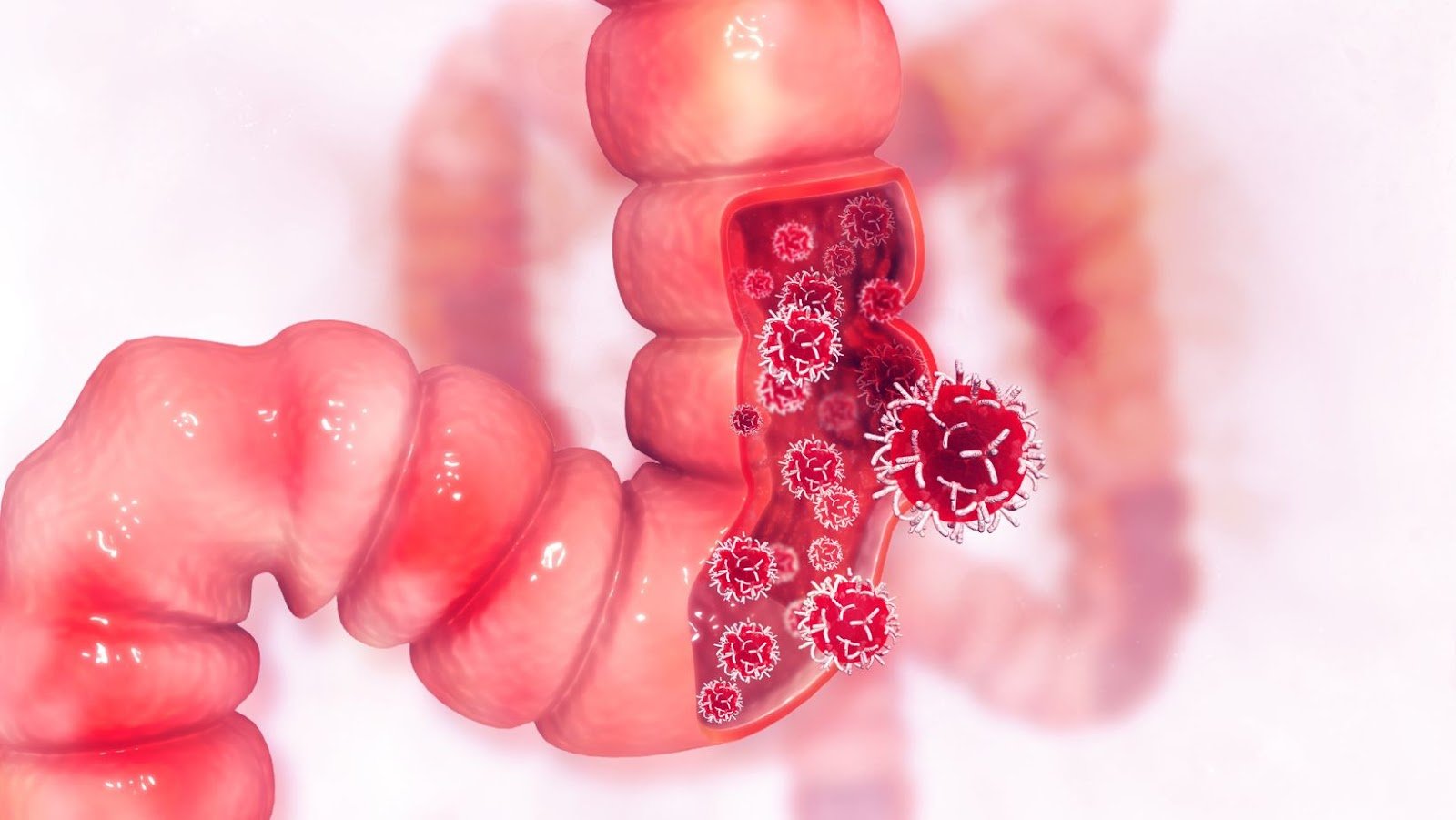 What Are The Warning Signs Of Colon Cancer