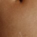 why does ash kash have a scar on her stomach