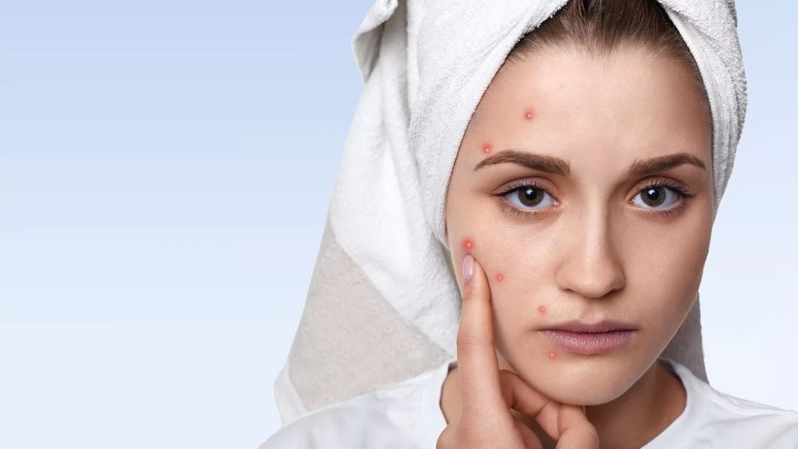 All you need to know about acne