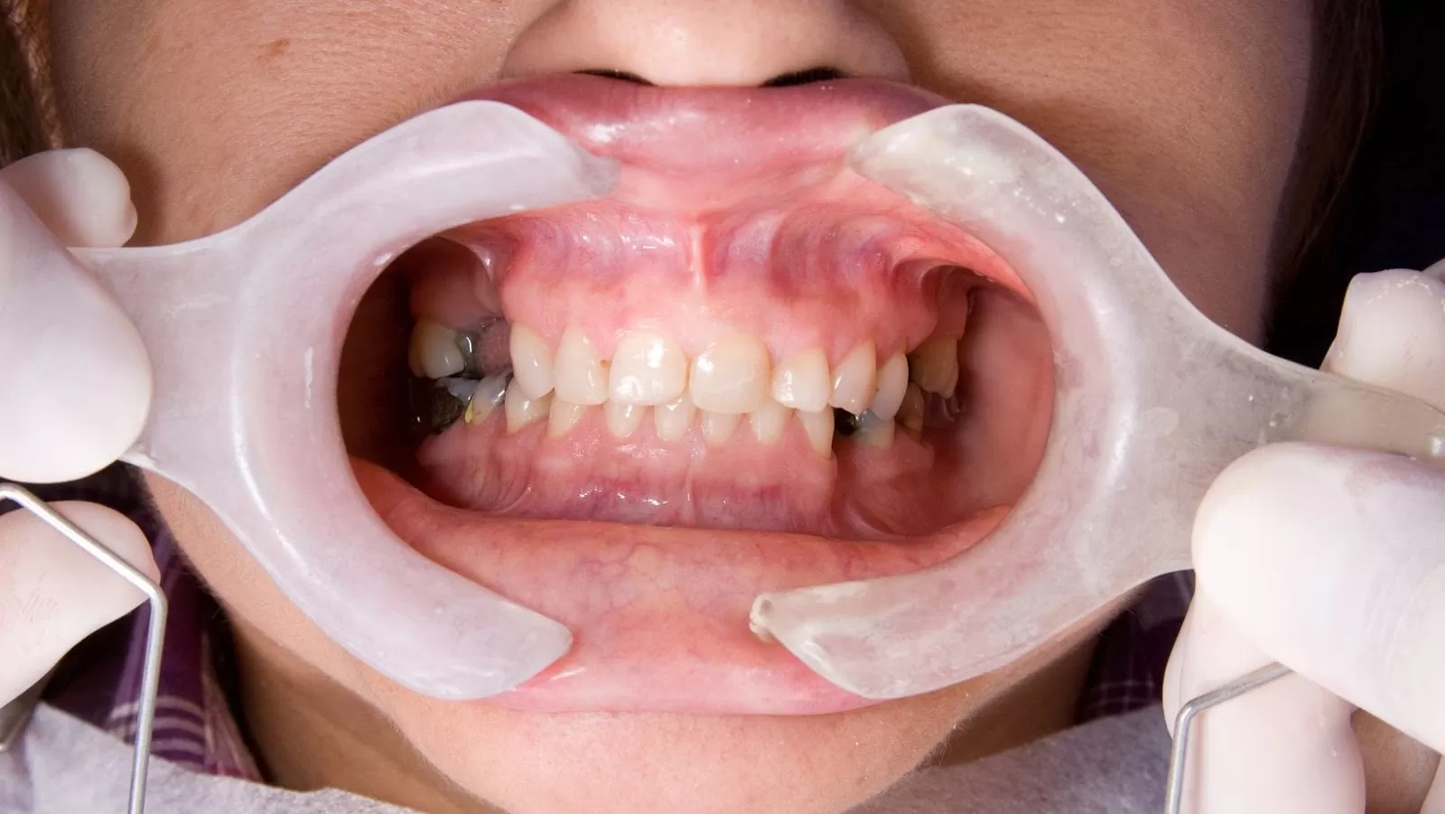 All You Should Know about Full Mouth Rehabilitation